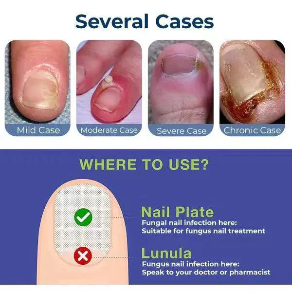 💅MD Anti-Paronychia Nail Relief Oil 🔥 Buy 1 Get 1 FREE  🔥